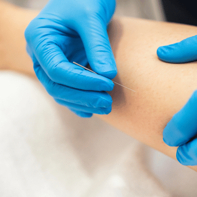 Physical therapist performing dry needling treatment on patient's arm
